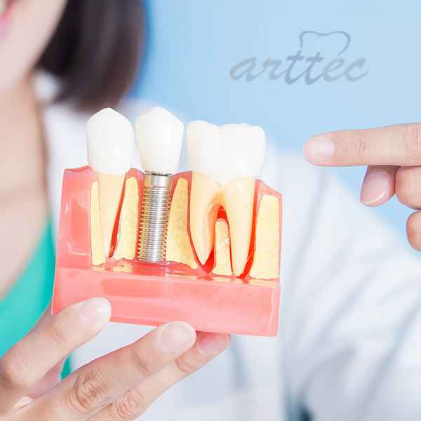 ایمپلنت دندان یا بریج