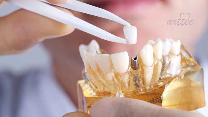 روشهای کاشت ایمپلنت دندان