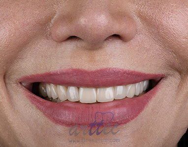 بازسازي لبخند مراجعه كننده عزيزمان با لمينت هاي سراميكي به همراه كاشت يك واحد ايمپلنت براي دندان شماره ١ پس از كشيدن ريشه دندان
